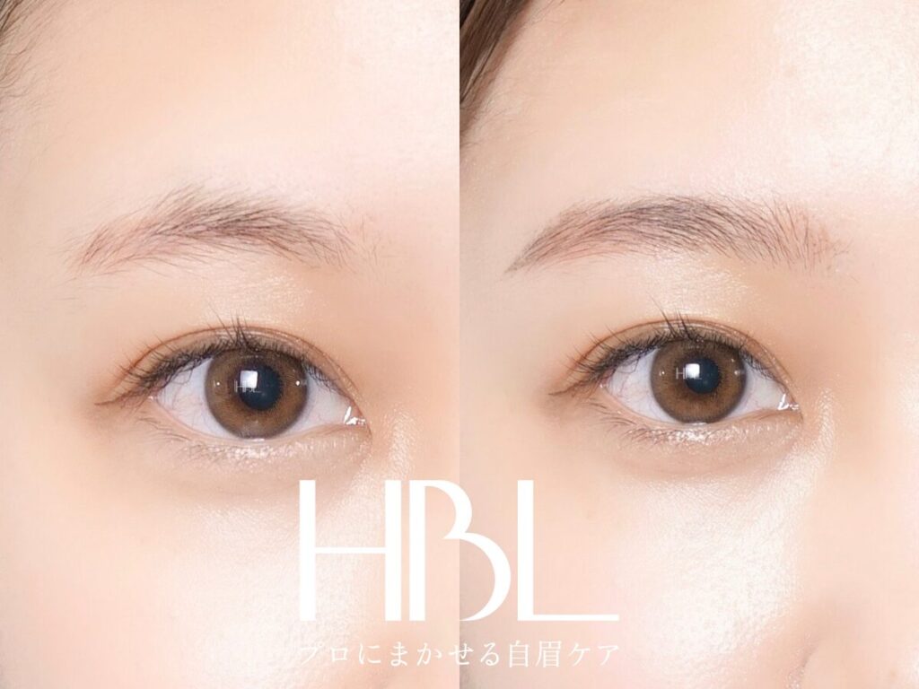 HBLとは？ ほかの施術との違いとは